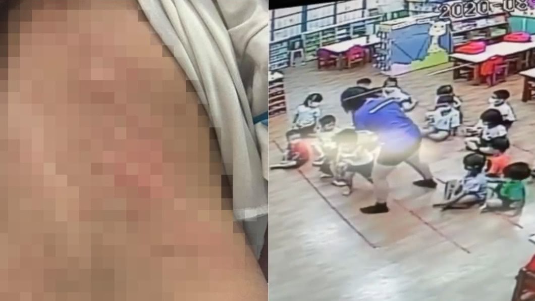 3歲童尿褲子…幼園師失控狂揍!掀衣「傷痕累累」父心碎