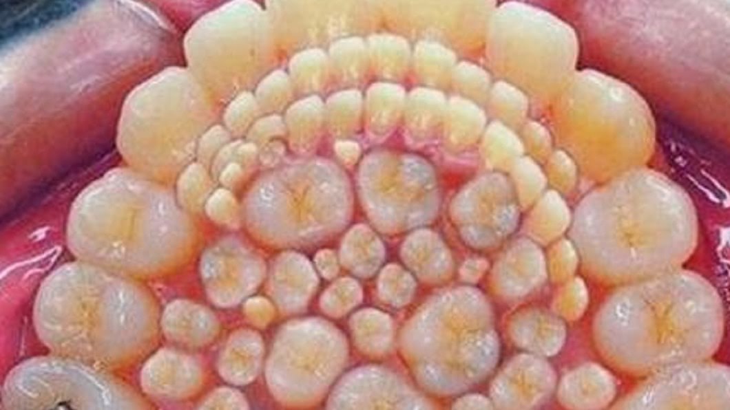 超密集!男童「300顆牙」塞滿嘴 1次狂拔40顆
