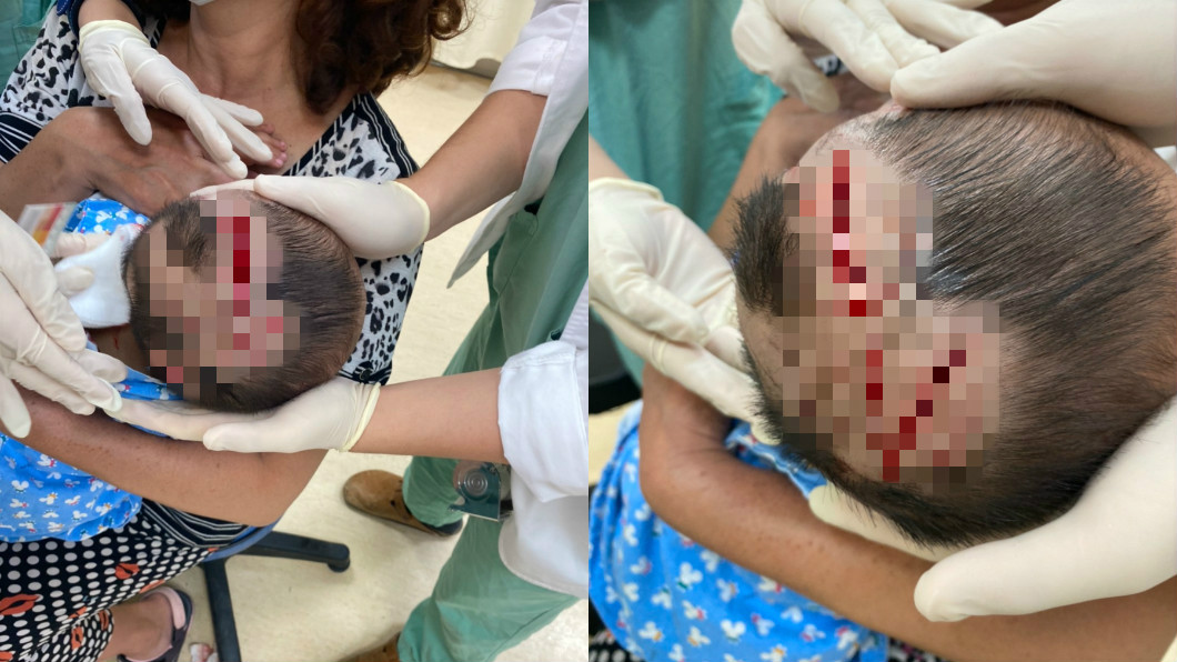 狗狗突發狂咬人!1歲童頭部皮開肉綻 傷口驚悚深及顱骨