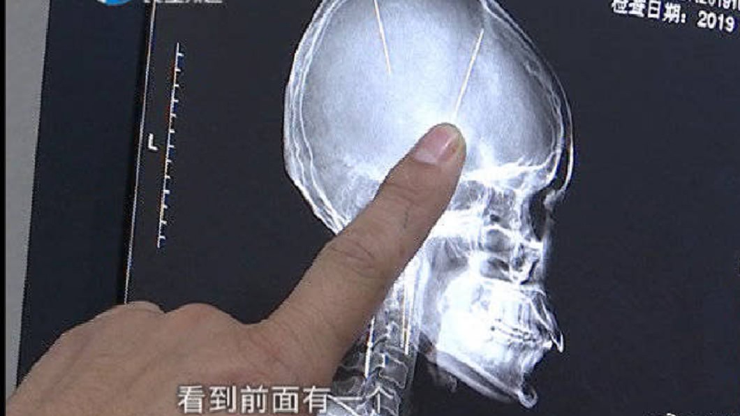 女子得知後十分驚訝,但表示身體並無任何異狀。(圖/翻攝自搜狐新聞)