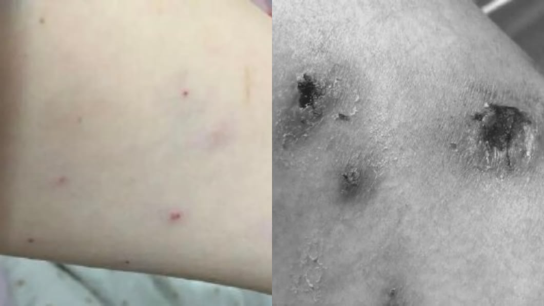 想靠打蛋白液減肥！2妙齡女全身潰爛…挨百刀挖肉仍無解