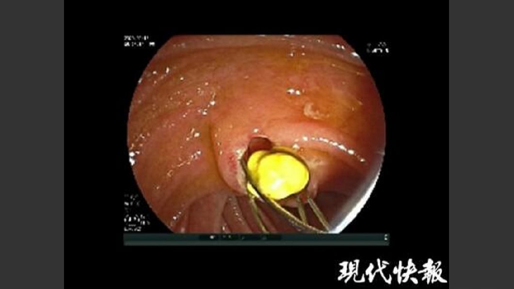 一名大陸11歲少女不吃早餐罹患膽結石。(圖/翻攝自現代快報)