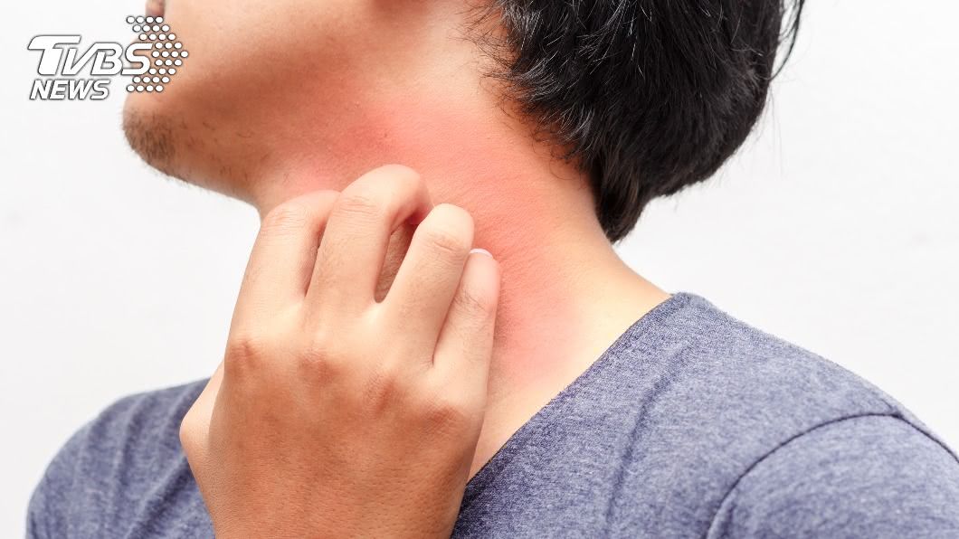 有異位性皮膚炎能泡澡? 「一事」做好反助於病情