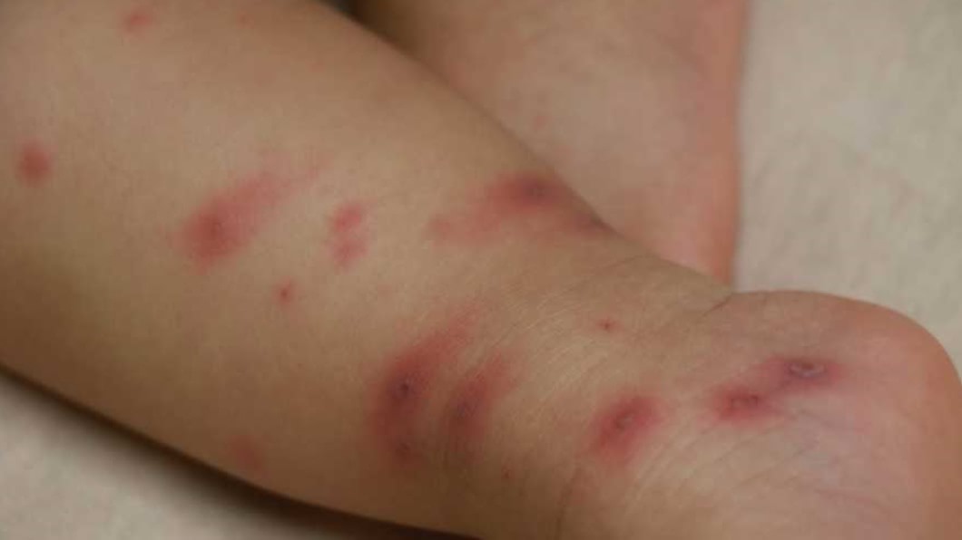 女嬰不明原因狂冒水痘母也遭殃 醫曝:恐致命