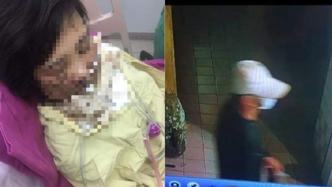 被潑硫酸毀容!台南女植皮「能整都整」淚求:幫我抓凶手