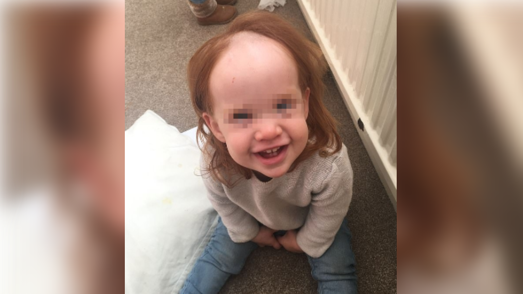 女童的頭髮大片脫落,瞬間變成禿頭。(圖/翻攝自Kirsty Saward FB)