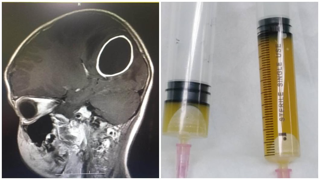 廣東一名8歲女童因為蛀牙拖了1年遲遲未治療,結果細菌侵襲腦部出現腦膿腫。(合成圖/翻攝自陸網)
