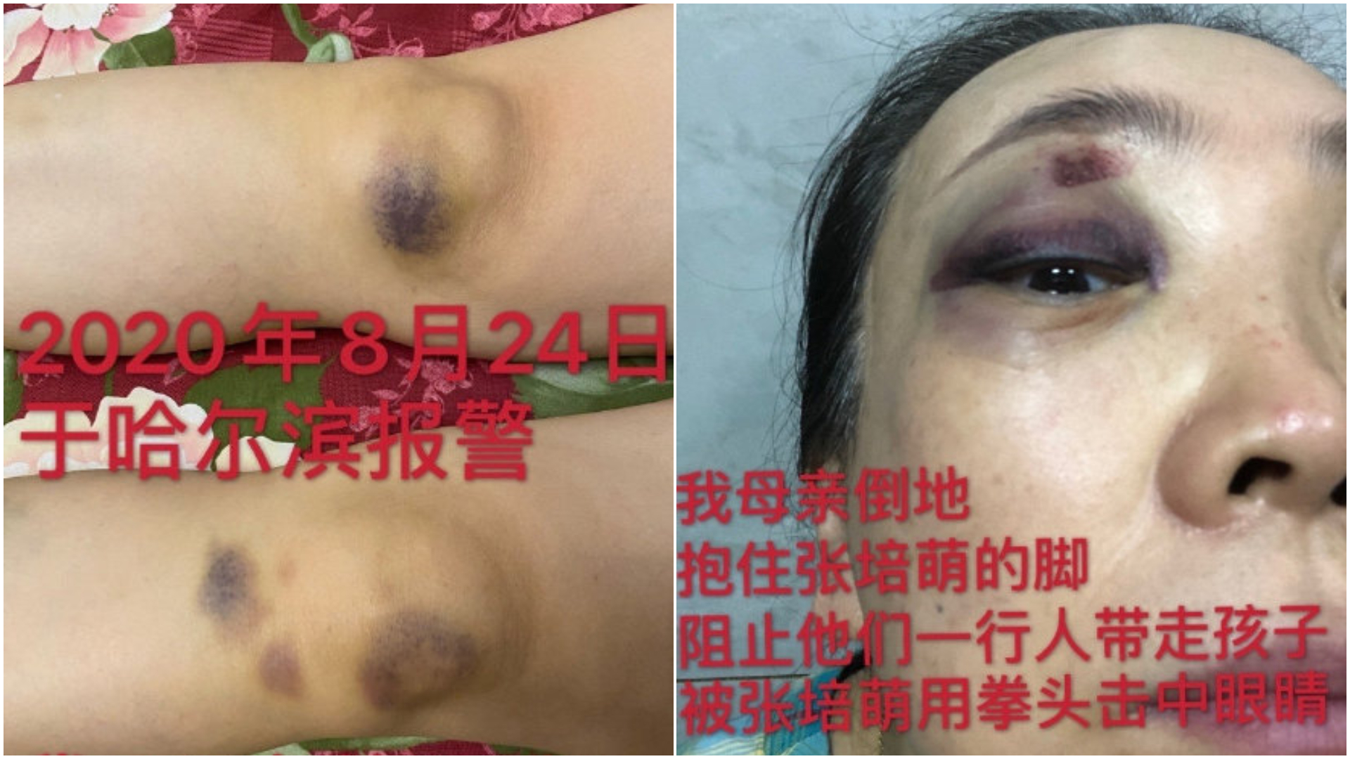 家人也遭張培萌毆打攻擊。(圖/翻攝自張莫涵微博)