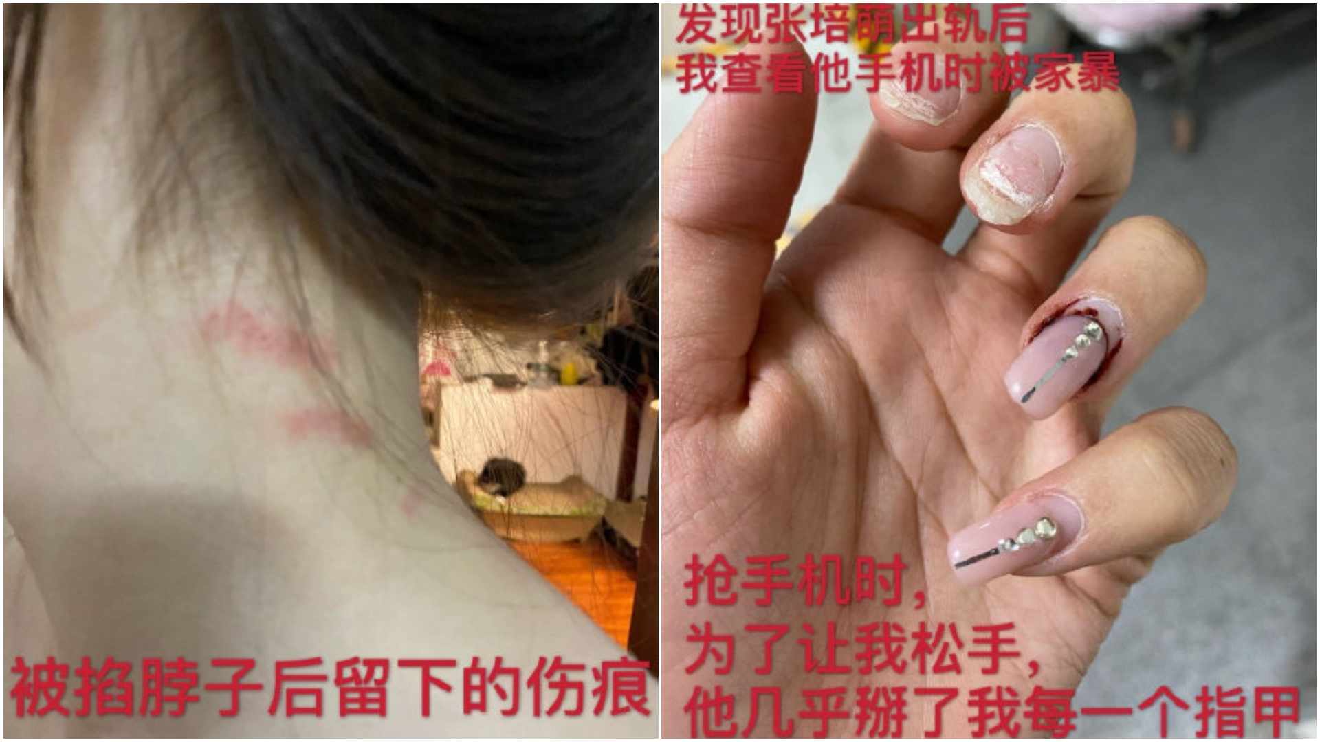 張莫涵全身多處瘀青。(圖/翻攝自張莫涵微博)
