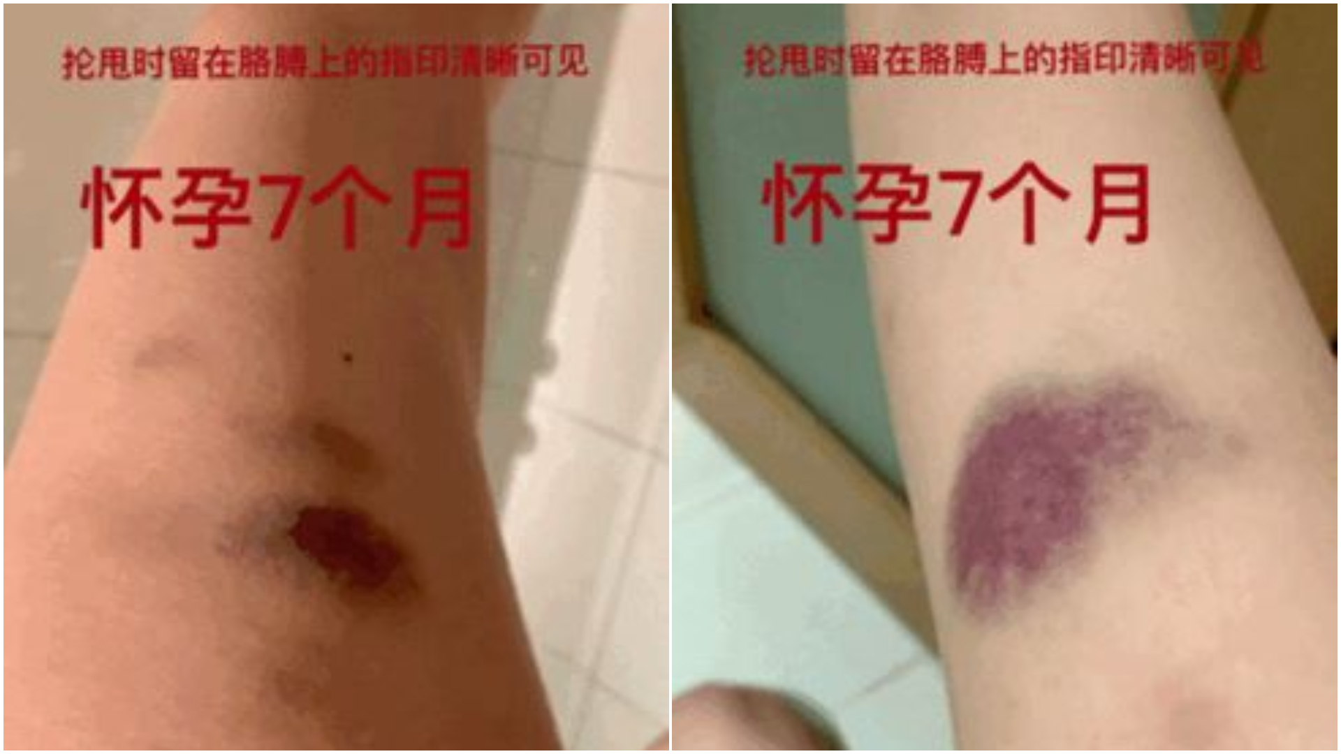 張莫涵懷孕期間遭夫家暴。(圖/翻攝自張莫涵微博)