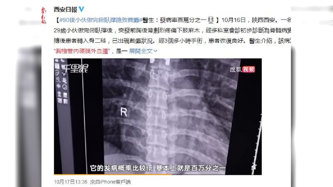 大陸一名壯男做伏地挺身做到一半,突然感到肚臍以下失去知覺。(圖/翻攝自微博)