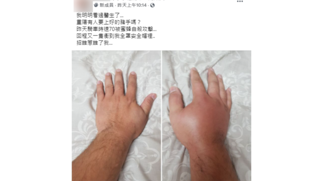 一名男子連遭2隻蜜蜂襲擊「腫成豬手」。(圖/翻攝自「爆怨2公社」)
