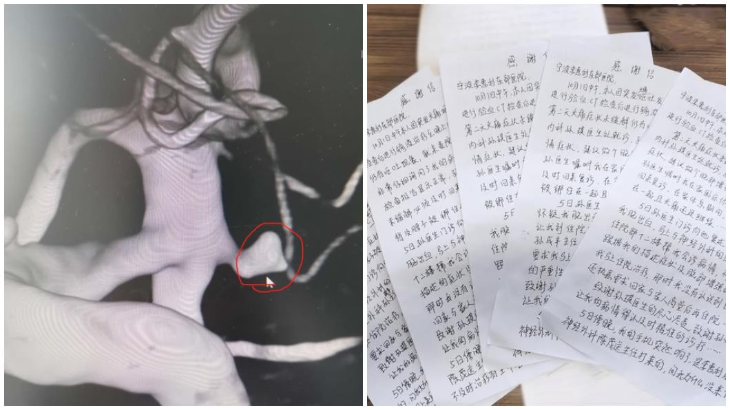 事後婦人去檢查,發現是蜘蛛網膜下腔出血,緊急開刀救回一命。(圖/翻攝自錢江晚報)