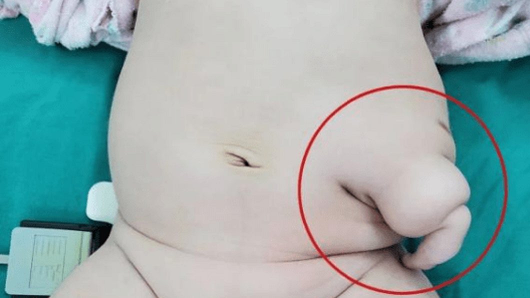 沒想到男嬰出生後,他的腹部左側竟然長出了一隻小手。(圖/翻攝自搜狐新聞)