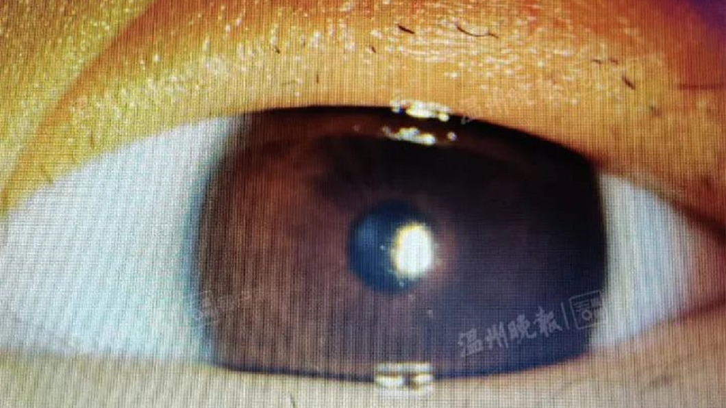 小陳睫毛全部掉光。(圖/翻攝自溫州晚報)