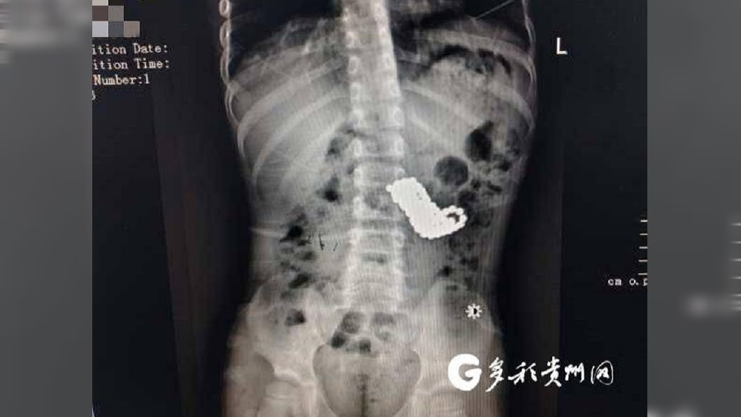 醫療團隊動了4.5小時的手術，才將男童體內的磁力珠全數取出。（圖／翻攝自搜狐新聞）