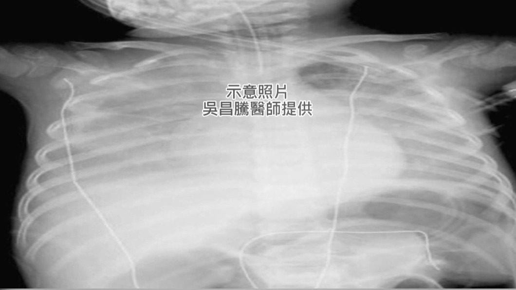 示意照片／吳昌騰醫師堤供