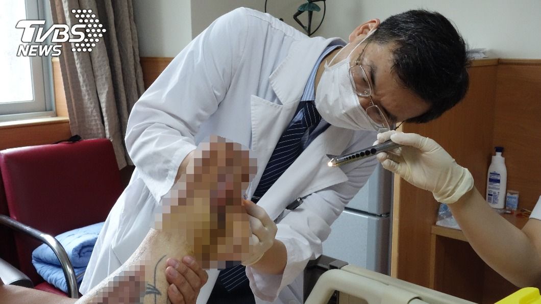 左腳發黑壞死引發敗血症、腎衰竭 男險死躺院75天