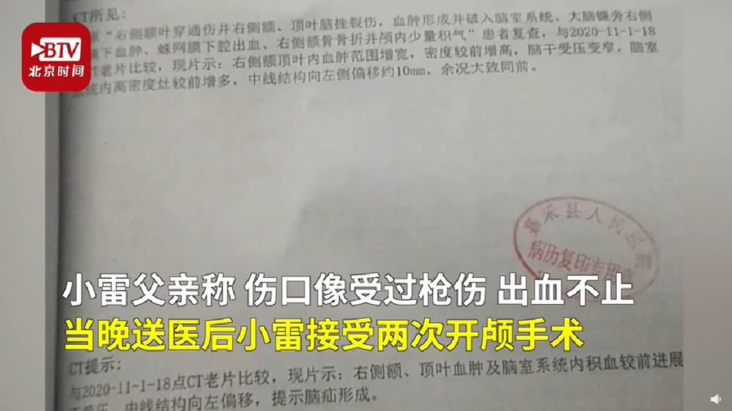 小雷的傷口如同槍傷。(圖/翻攝自北京時間)