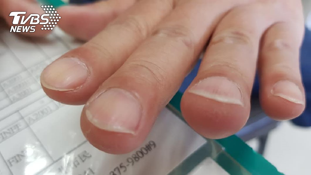 手指尖端腫起。(圖/胸腔重症醫師蘇一峰授權提供)