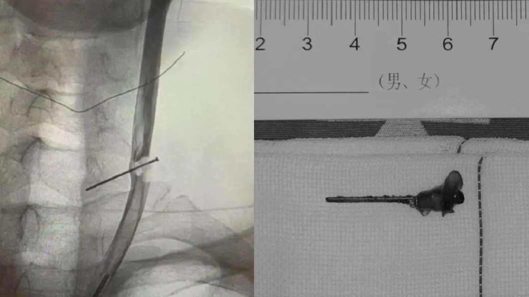 男眼前發黑急就醫 驚見「3公分鐵釘」穿頸動脈10年