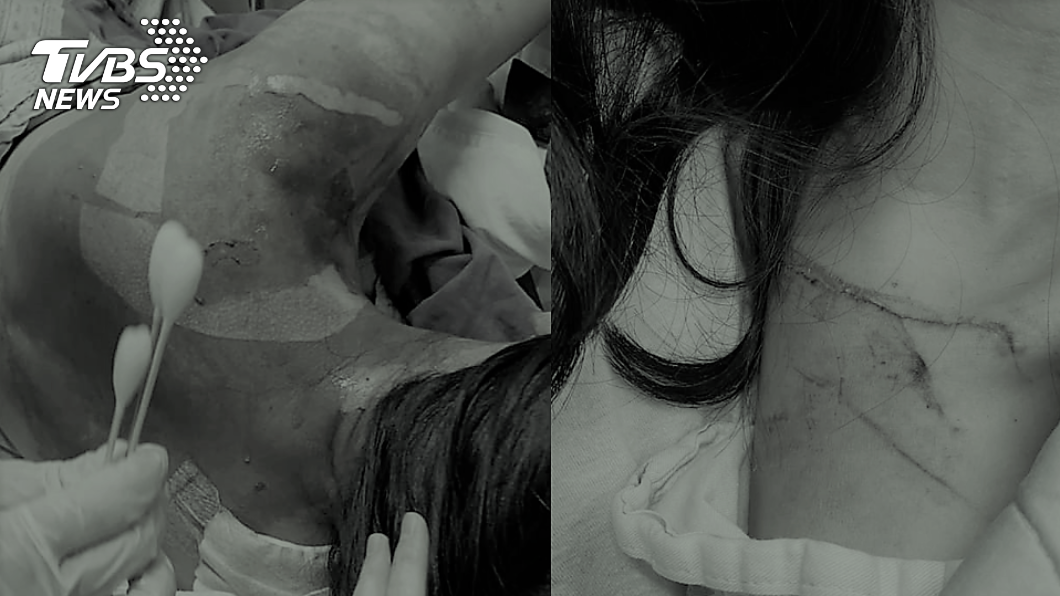 程女二度燒燙傷非常痛苦。(經變色處理,合成圖/當事人授權提供)