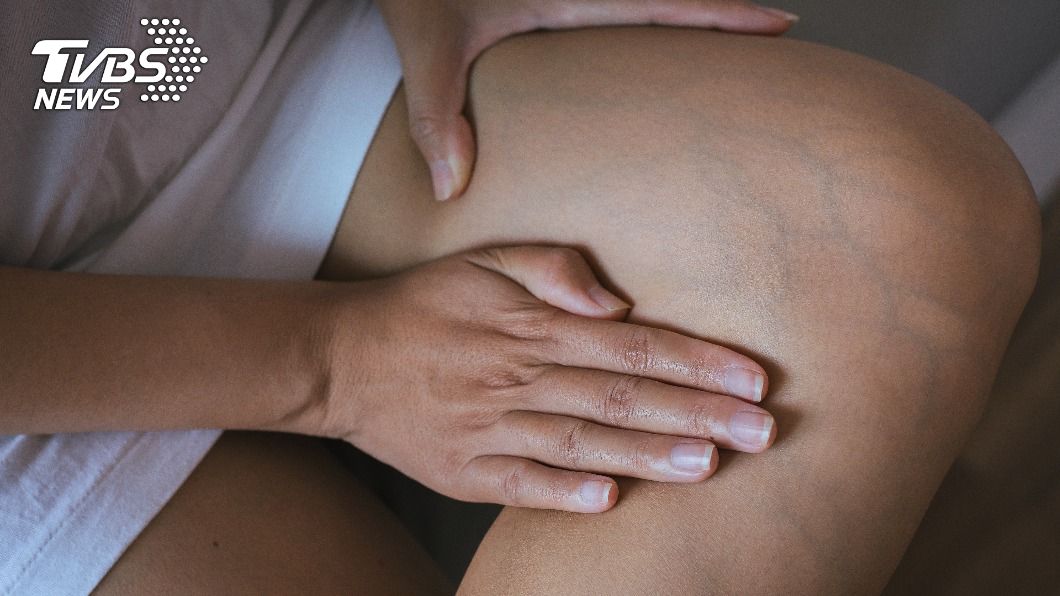 睡覺腿總是痠麻癢?4徵兆檢測「不寧腿症」