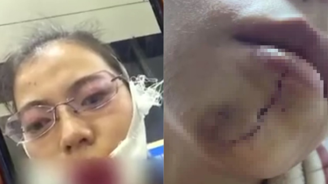 收貨等太久!女遭毆臉裂噴血 快遞「揍一拳」代價43萬