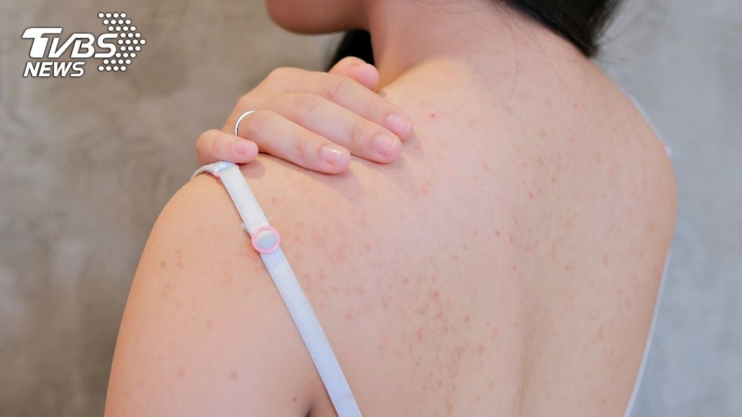 背部總是狂冒痘?3招KO囊腫粉刺 避免皮脂塞住毛孔
