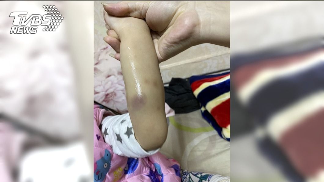 女童尿布都是血+多處瘀青以為受虐 急送醫發現罹罕病
