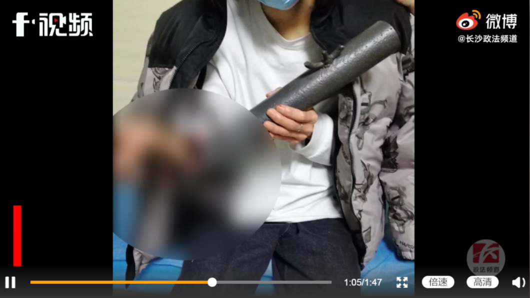 男大生經縫合清創後已無大礙。（圖／翻攝自微博／長沙政法頻道）
