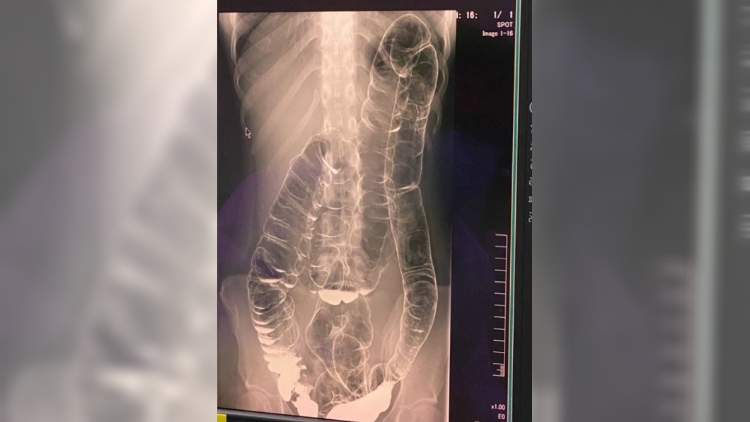 便秘17天!女「大腸長到心臟」壓迫肺 照片曝光嚇傻
