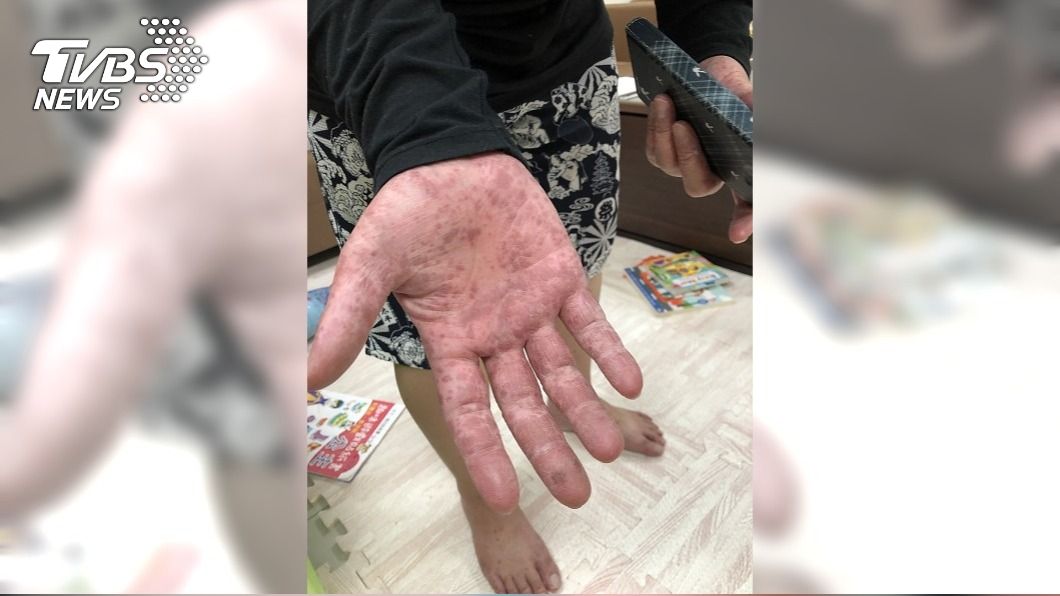腸病毒傳染力強 父照顧女兒沒洗手也感染