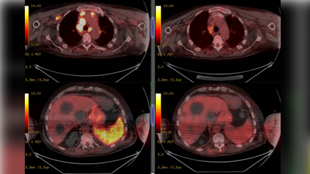 對比染疫前(左)、染疫後(右),大部分腫瘤消失。(圖/翻攝自《British Journal of Haematology》