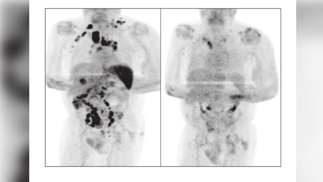 對比染疫前(左)、染疫後(右),大量癌細胞消失。(圖/翻攝自《British Journal of Haematology》