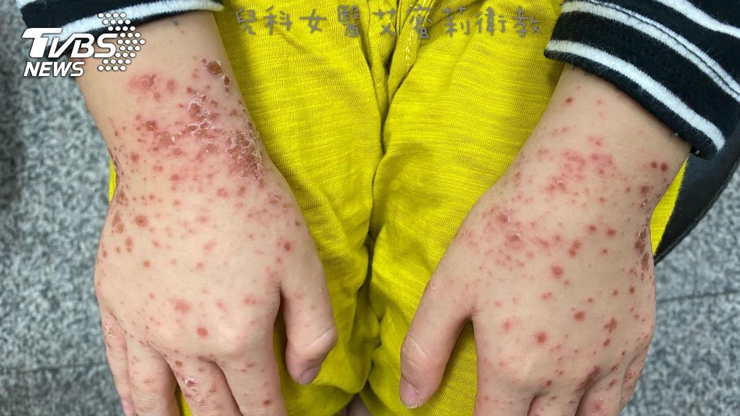 腸病毒引發手足口病造成水泡。(圖/「兒科女醫艾蜜莉-歐淑娟醫師」授權提供)