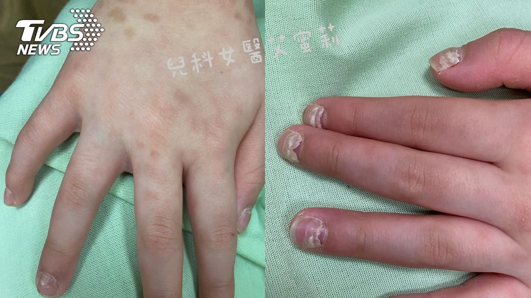男童近期為脫甲症所苦,皮膚也留下水泡的痕跡。(圖/「兒科女醫艾蜜莉-歐淑娟醫師」授權提供)