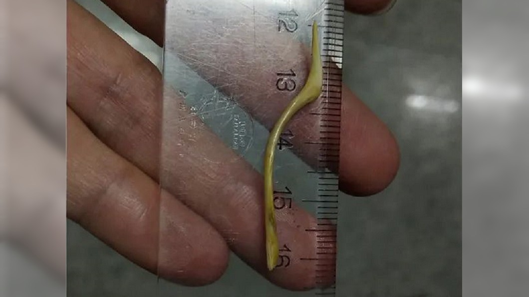 吃飽飯突劇烈腹痛 醫見「4公分魚刺」貫穿小腸