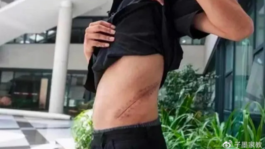 該名少年因賣腎而留下永久的傷疤以及後遺症。(圖/翻攝自「子墨家教」微博)