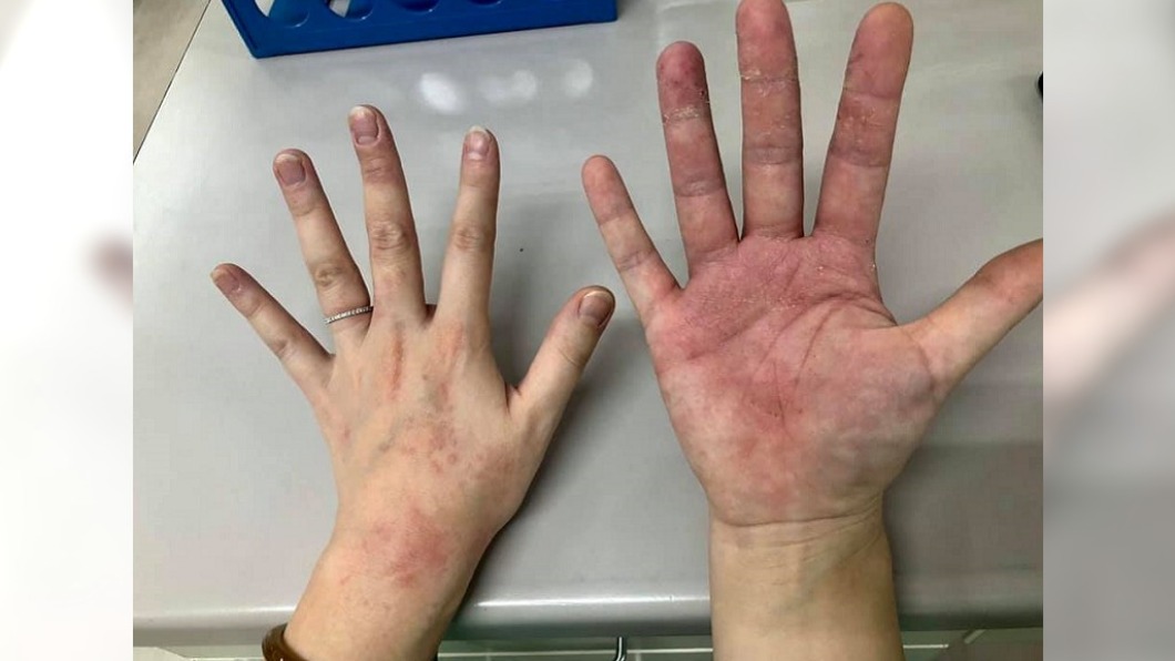 抗疫醫護雙手「破皮起紅疹」 護理長心疼:從沒抱怨過