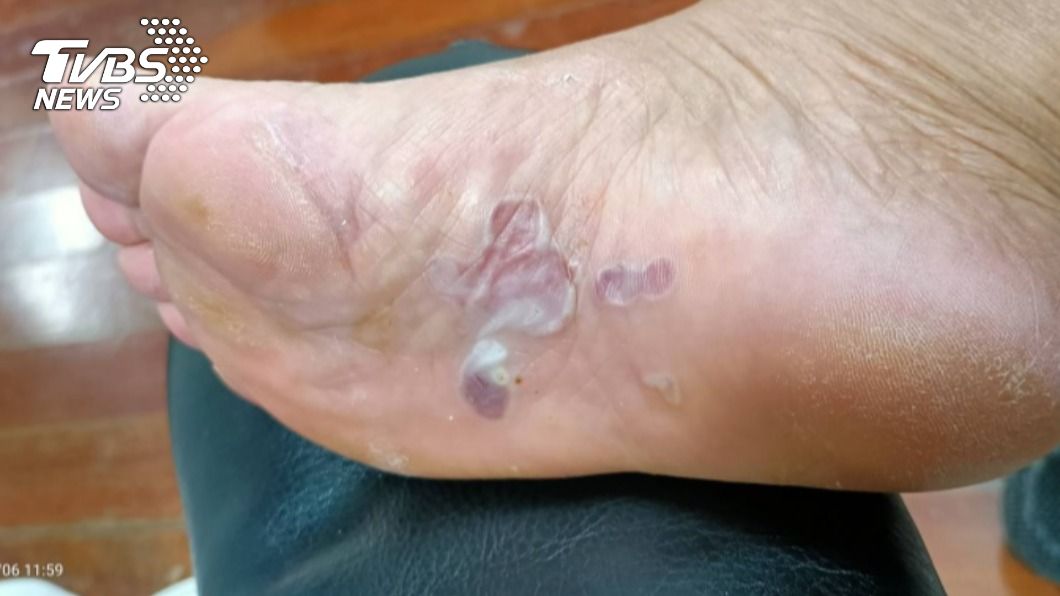 老婦「暖暖包貼腳底」還套襪 起床遭燙傷起水泡