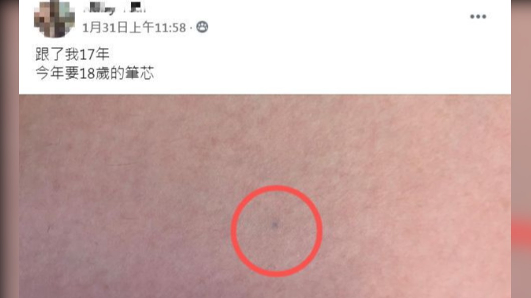 女子皮膚上的「黑痣」其實是鉛筆筆芯。(圖/翻攝自臉書社團「爆廢公社」)