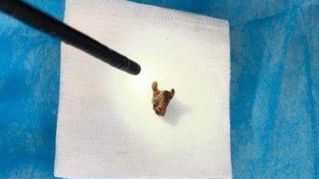 醫師從老翁氣管內取出一顆生鏽的假牙。(圖/翻攝自華商網)