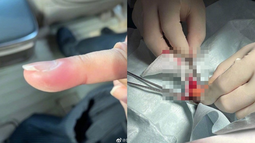 鄧萃雯因倒刺手指感染腫脹,入院開刀。(圖/翻攝自鄧萃雯微博)