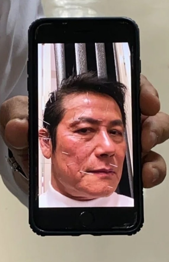 徐乃麟曝光滿臉扎針的驚悚照片。(圖/翻攝自天才衝衝衝臉書)