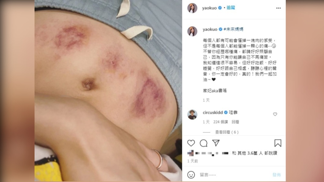 郭書瑤近日在社群平台貼出肚皮照,令人看了怵目驚心。(圖/翻攝自郭書瑤IG)