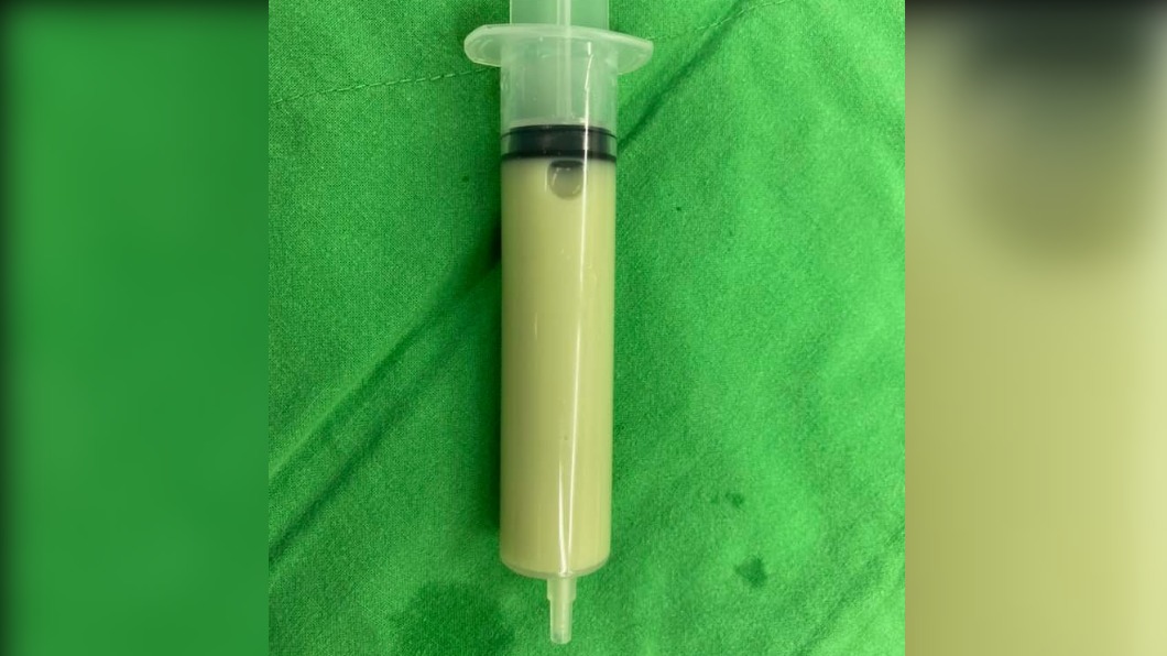 婦腰痠數週就診 醫抽出「抹茶尿」驚:腎功能剩50%
