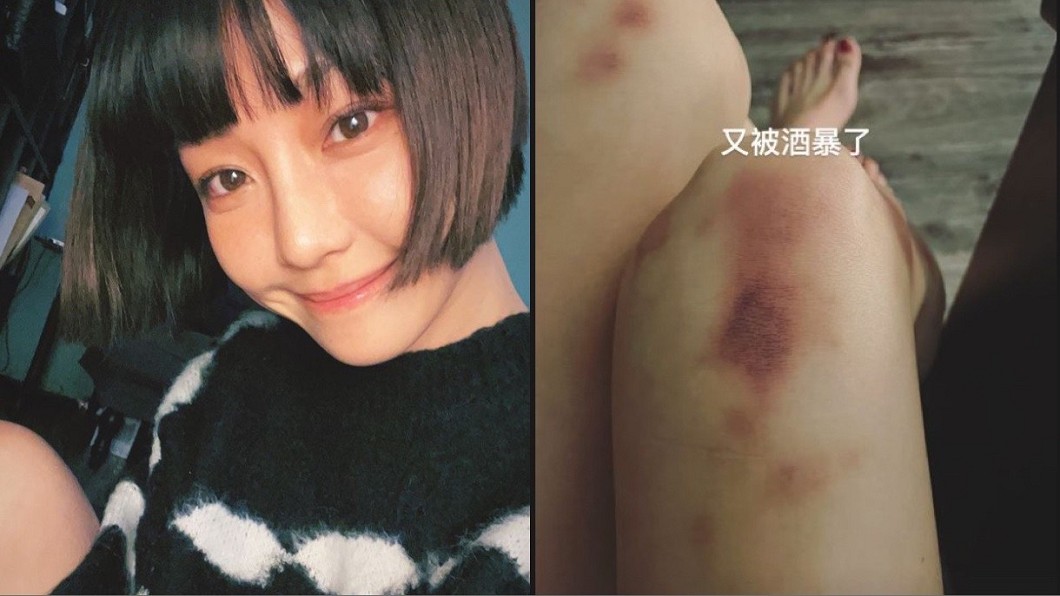 女星雙腿瘀青突喊「又被酒暴!」 經紀人:沒被毆打