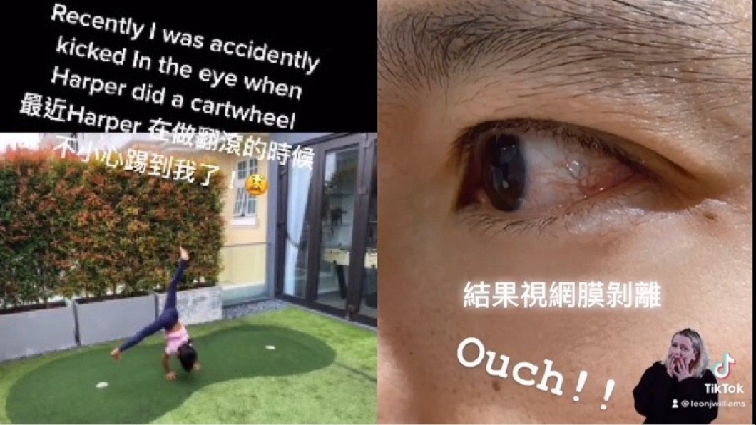 立威廉發抖音稱遭女兒踢到左眼,就醫後發現視網膜剝離。(圖/翻攝自立威廉微博)