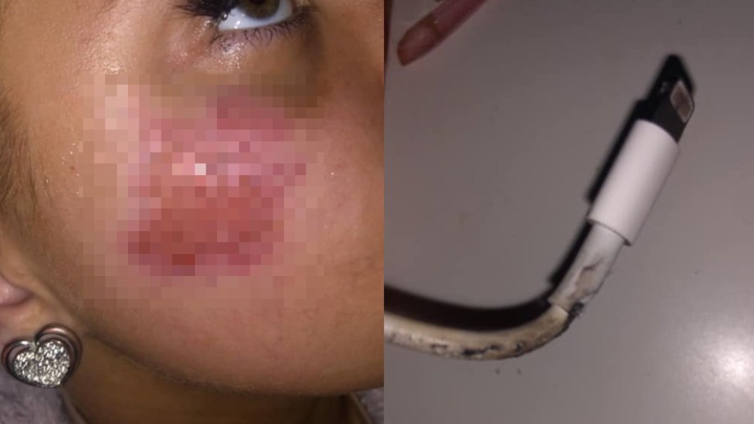 iPhone充電突起火 英女熟睡「遭火吻臉頰」嚇醒